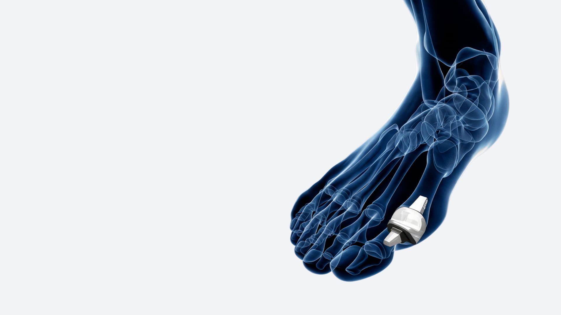 brm-silktoe-radiografia