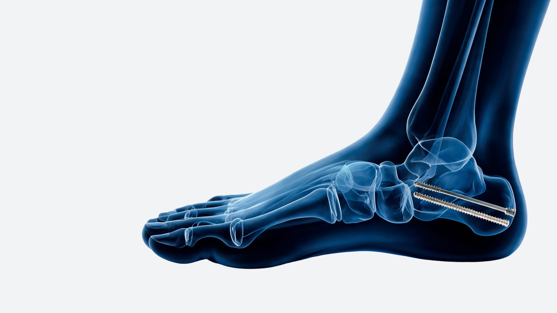 brm-viti-brm-tool-pro-radiografia