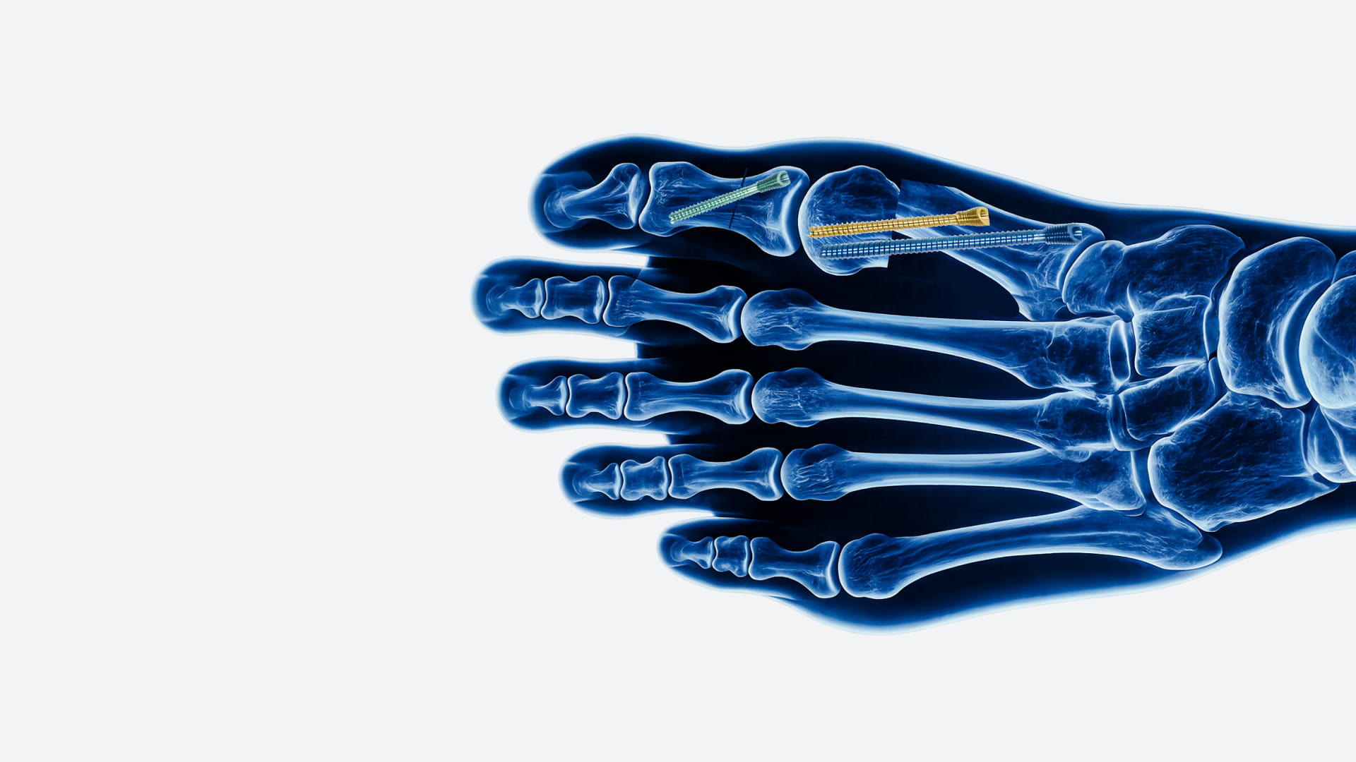 brm-viti-brm-tool-vip-radiografia-piede
